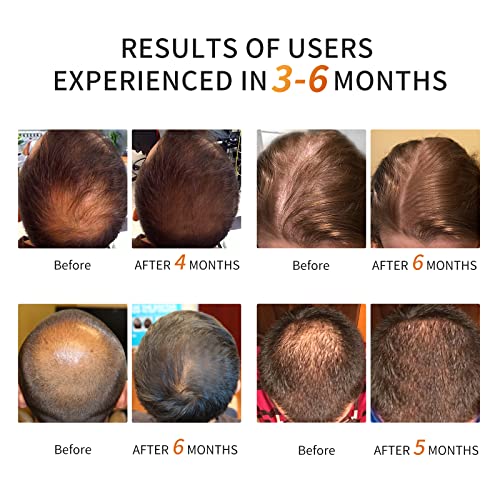 COSBEAUTY Professional Hair Growth Laser Cap-FDA a eliminat terapia cu Laser de nivel scăzut regenerarea părului pentru bărbați